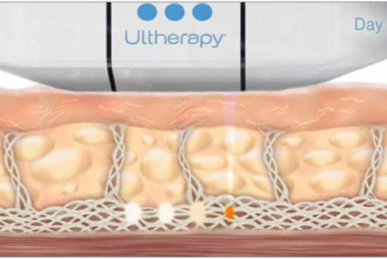 ULTherapy